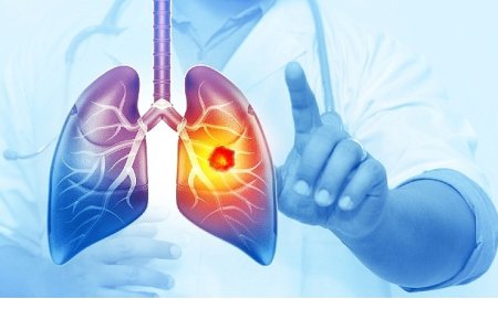Her Yıl 25 Bin Akciğer Kanseri Vakası Önlenebilir