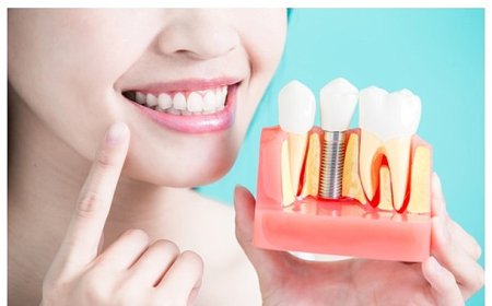 Diş İmplantları Hakkında Bilmeniz Gereken 9 Bilgi!