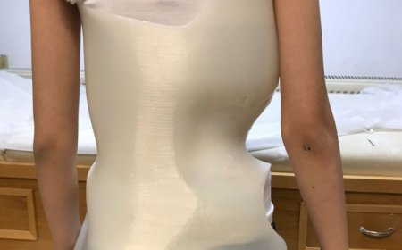 Bursa’da skolyoz tedavisinde devrim